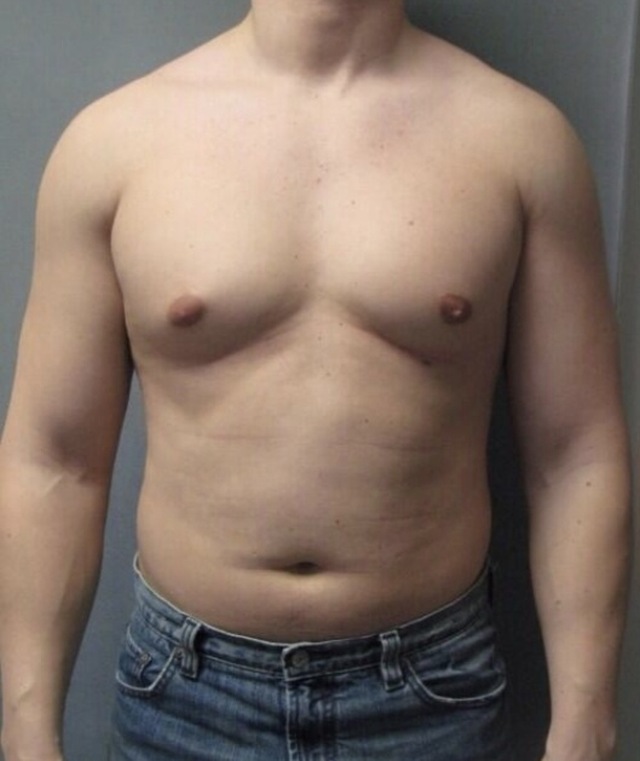 Client's male chest before Aqualyx treatment at Portland Body Clinic