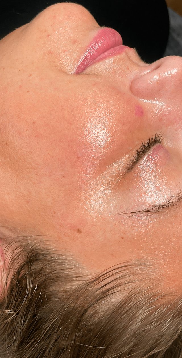 Client's cheek after Million Dollar Facial treatment at Portland Body Clinic