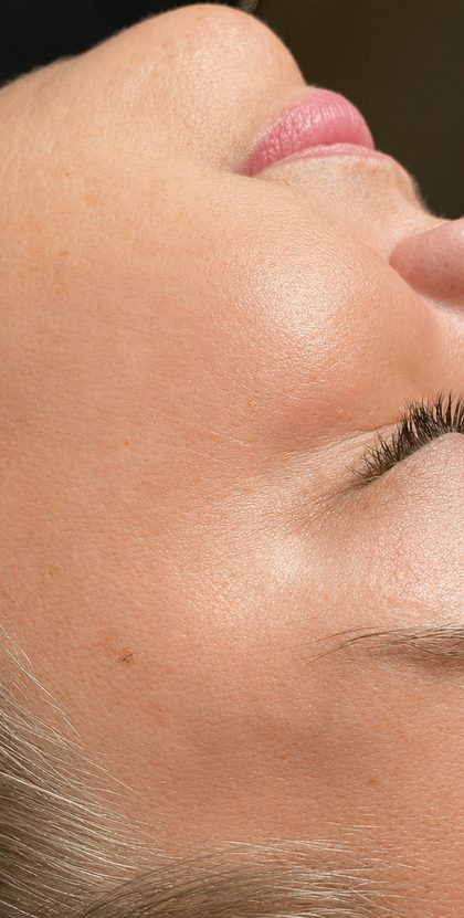 Million Dollar Facial result at Portland Body Clinic — before