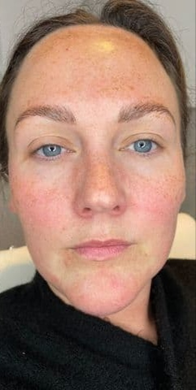 Client's face after Neofound Whitening treatment at Portland Body Clinic