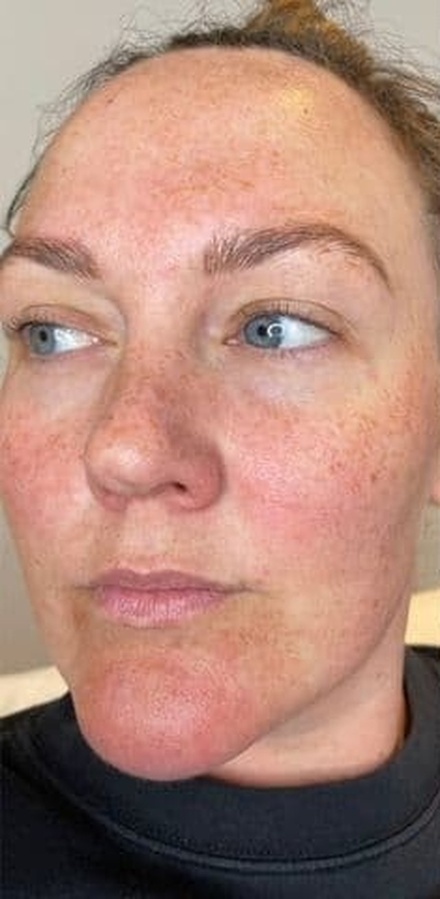 Client's face before Neofound Whitening treatment at Portland Body Clinic
