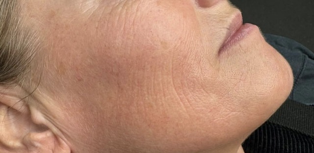 Client's lower face and jawline after Profhilo treatment at Portland Body Clinic