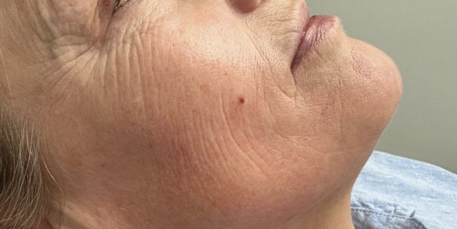Client's lower face and jawline before Profhilo treatment at Portland Body Clinic