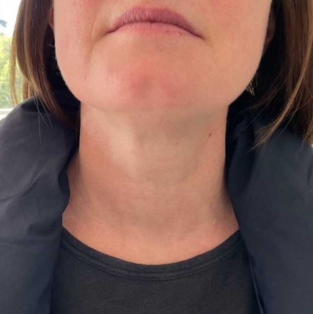Client's neck after Profhilo treatment at Portland Body Clinic