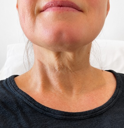Profhilo result at Portland Body Clinic — before