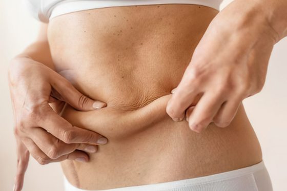 Loose abdominal skin remaining after significant weight loss, at Portland Body Clinic Cardiff