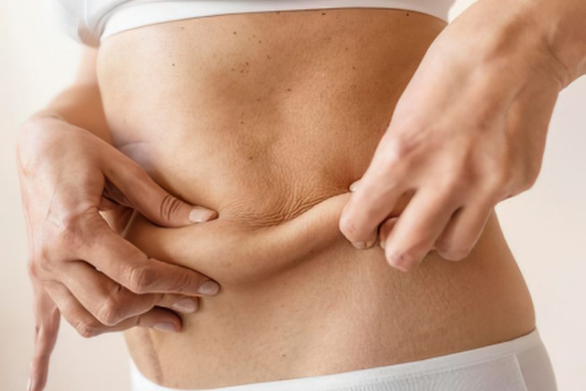Loose abdominal skin remaining after significant weight loss, at Portland Body Clinic Cardiff