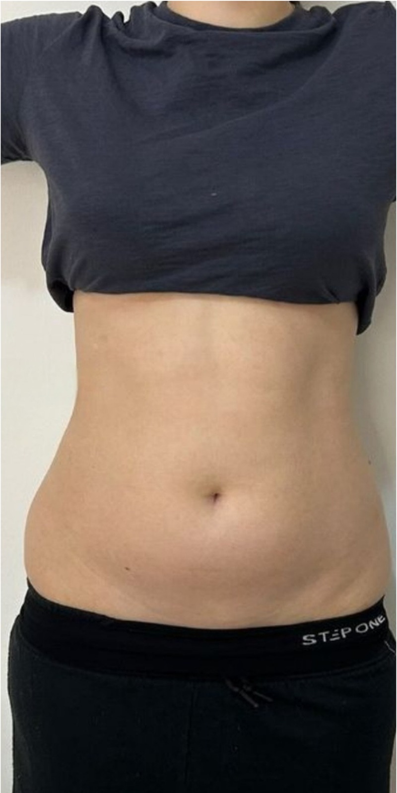 Client's abdomen after 360 degree Fat Freezing treatment at Portland Body Clinic