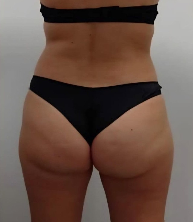 Client's glutes before Wonder Butt Lift treatment at Portland Body Clinic