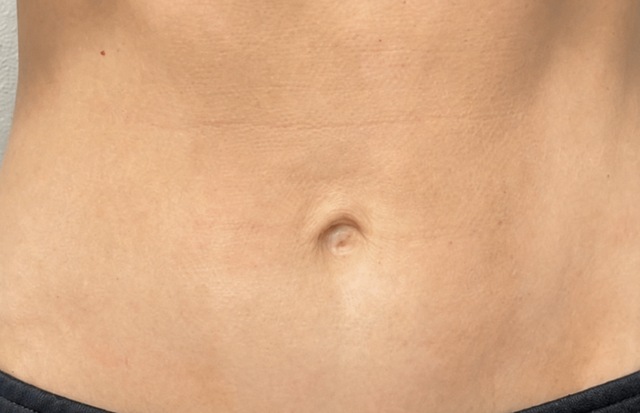 Client's abdomen after DermaPro RF treatment at Portland Body Clinic
