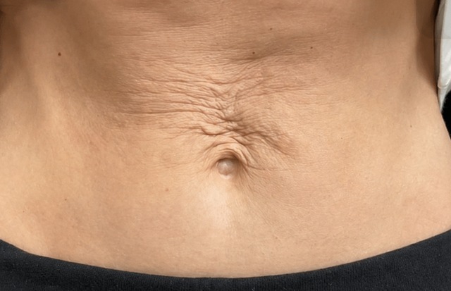 Client's abdomen before DermaPro RF treatment at Portland Body Clinic
