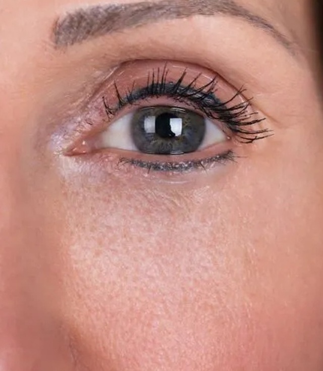 Client's under-eye area after Profhilo treatment at Portland Body Clinic