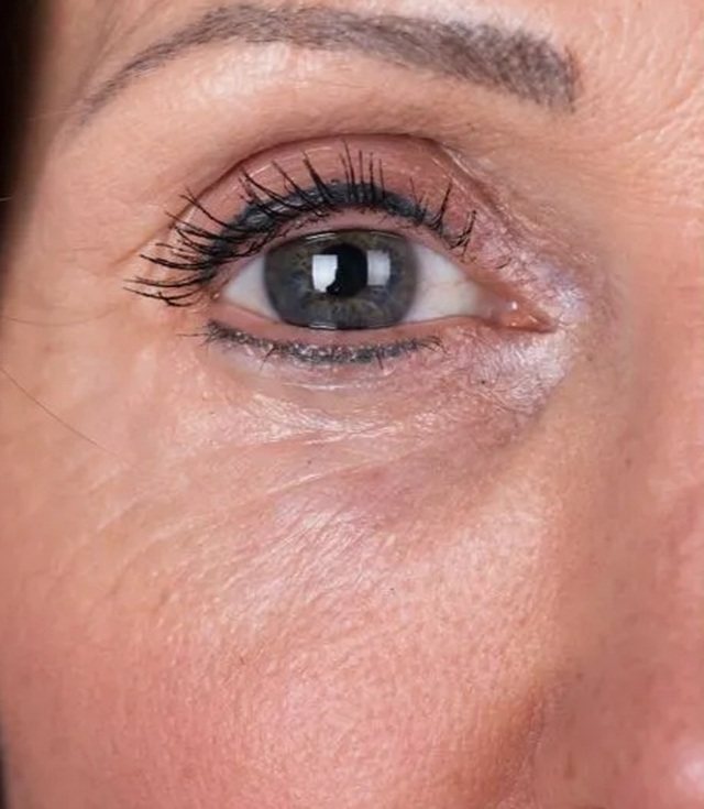 Client's under-eye area before Profhilo treatment at Portland Body Clinic