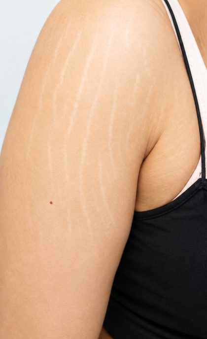 Stretch Mark Treatment result at Portland Body Clinic — before