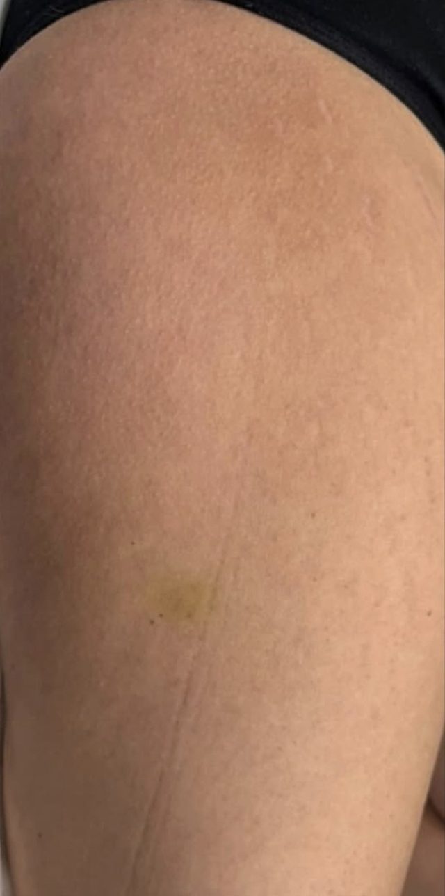 Client's thigh after Dermapen microneedling treatment at Portland Body Clinic