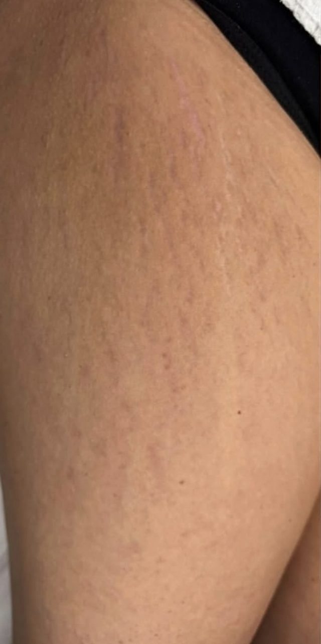 Client's thigh before Dermapen microneedling treatment at Portland Body Clinic