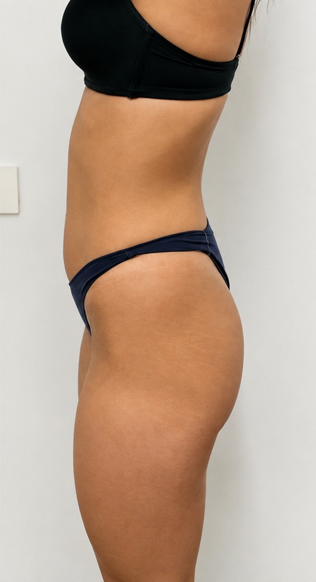 Client's glutes before Wonder Butt Lift treatment at Portland Body Clinic