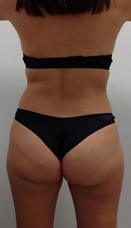 Wonder Butt Lift result at Portland Body Clinic — before