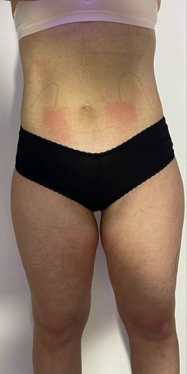Client's abdomen after Wonder Body muscle toning treatment at Portland Body Clinic