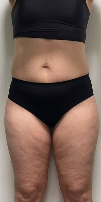 Wonder Body result at Portland Body Clinic — before