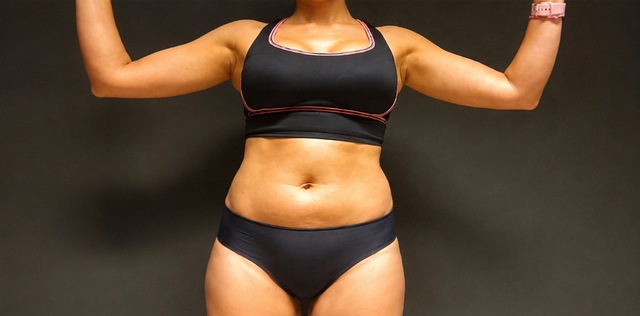 Client's abdomen before Wonder Body muscle toning treatment at Portland Body Clinic