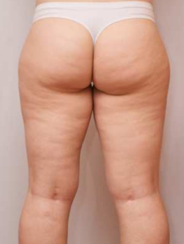 Client's thighs and buttocks before Wonder Smooth treatment at Portland Body Clinic