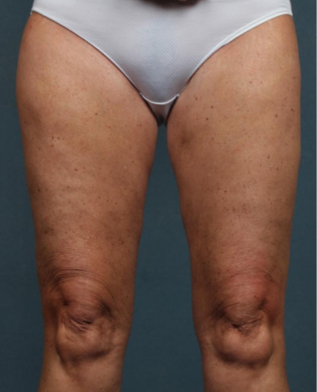 Client's thighs after Wonder Smooth cellulite treatment at Portland Body Clinic