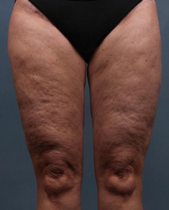 Client's thighs before Wonder Smooth cellulite treatment at Portland Body Clinic